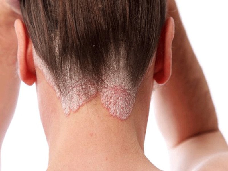 Điều trị nấm da đầu như thế nào?