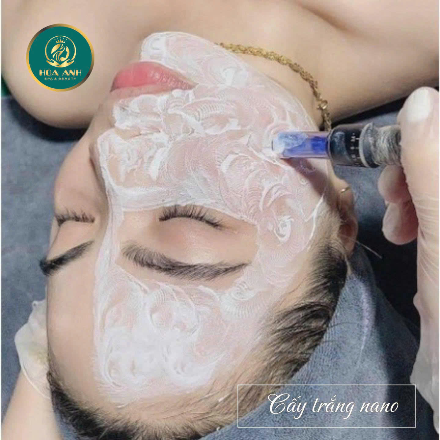 Cấy Trắng Nano Có Lợi Ích Gì? Tìm Hiểu Từ A đến Z