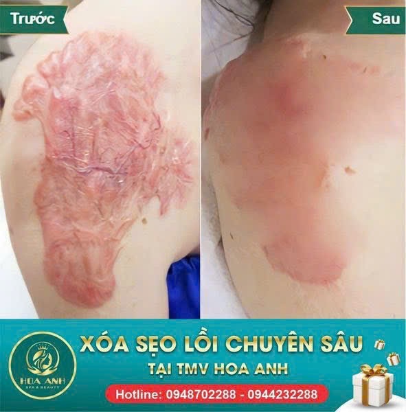 Dịch Vụ Trị Sẹo Lồi Hiệu Quả, An Toàn Tại Thẩm Mỹ Viện Hoa Anh