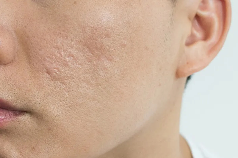 SẸO RỖ - NGUYÊN NHÂN VÀ CÁCH ĐIỀU TRỊ