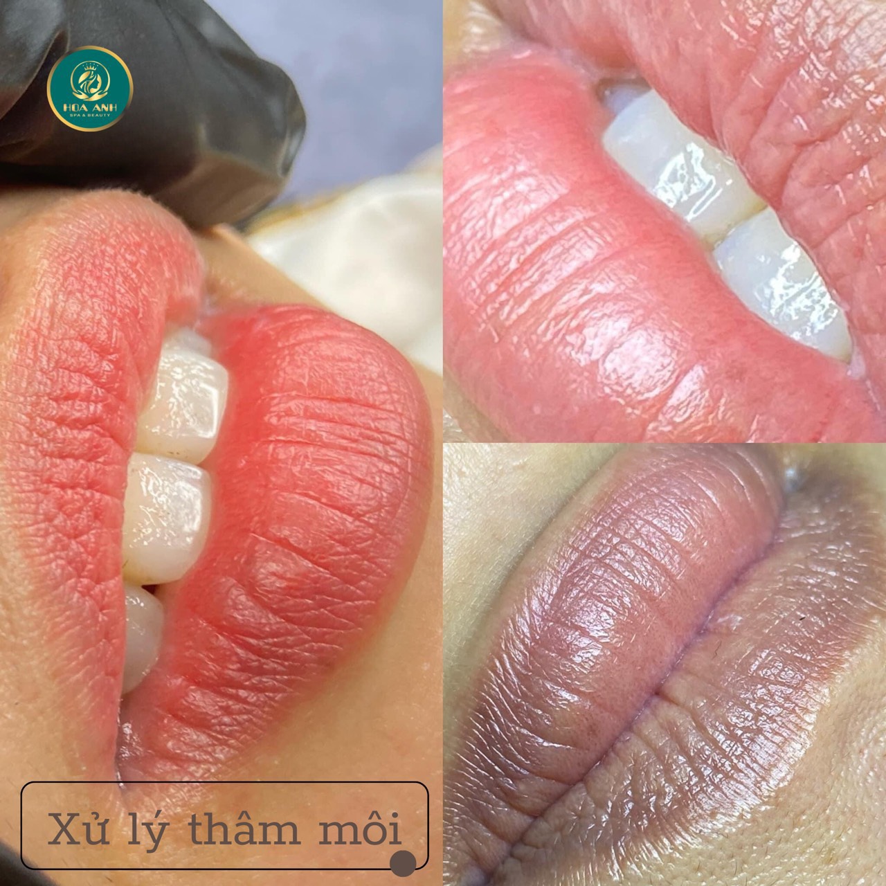 XỬ LÍ THÂM MÔI