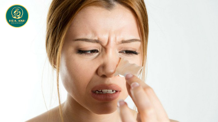 Cách trị mụn đầu đen ở mũi và lỗ chân lông to