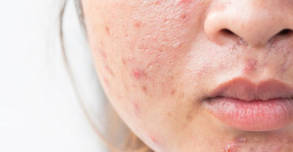 4 Sản phẩm tự nhiên để loại bỏ sẹo mụn