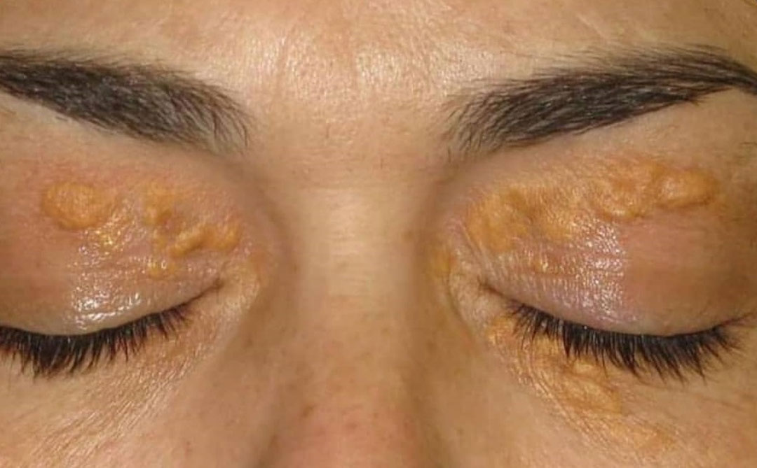MỠ GÀ LÀ GÌ? NGUYÊN NHÂN, CÁCH ĐIỀU TRỊ VÀ CHIA SẺ TỪ CHUYÊN GIA THẨM MỸ QUỐC TẾ HOA ANH