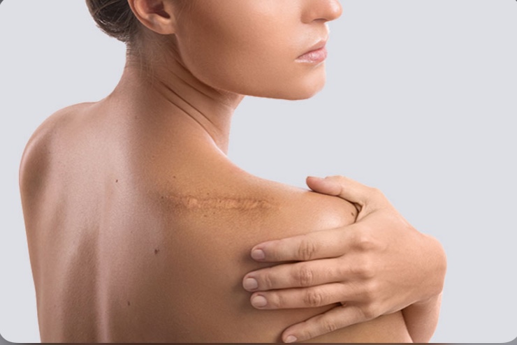 Ai nên tiêm sẹo lồi? Tiêm sẹo lồi có hết không?
