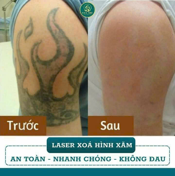 Xóa Xăm Bằng Laser Có An Toàn Và Hết Không? Câu Trả Lời Từ Thẩm Mỹ Viện Hoa Anh