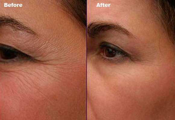 Tiêm botox đuôi mắt bao nhiêu tiền?