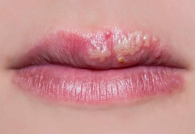 Mụn Nước Sau Khi Phun Môi Có Ảnh Hưởng Gì Đến Sức Khỏe Không?