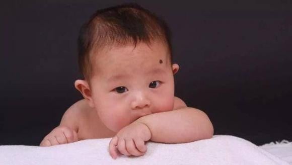 Xóa Nốt Ruồi Cho Bé Có An Toàn Hay Không? – Những Điều Cha Mẹ Cần Biết