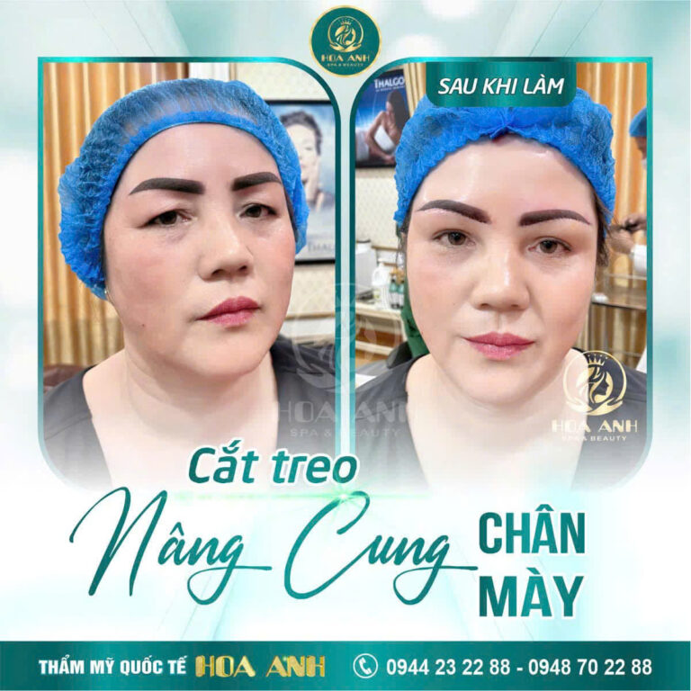 Treo Khung Chân Mày Có Nguy Hiểm Không? Bác Sĩ Chia Sẻ Toàn Diện Từ A–Z