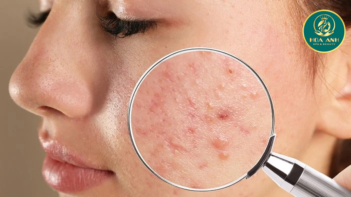 Trị mụn trứng cá bằng kem đánh răng - hiệu quả không?