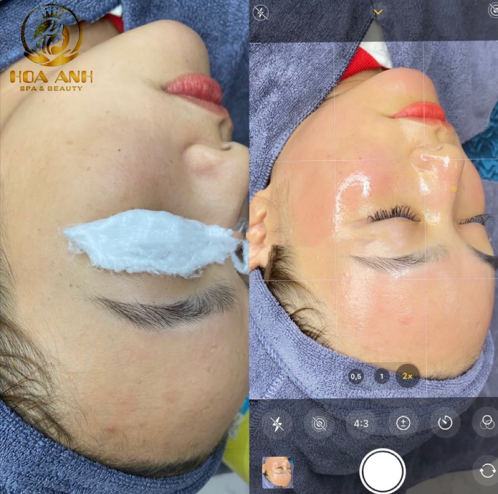Tiêm meso bao lâu 1 lần