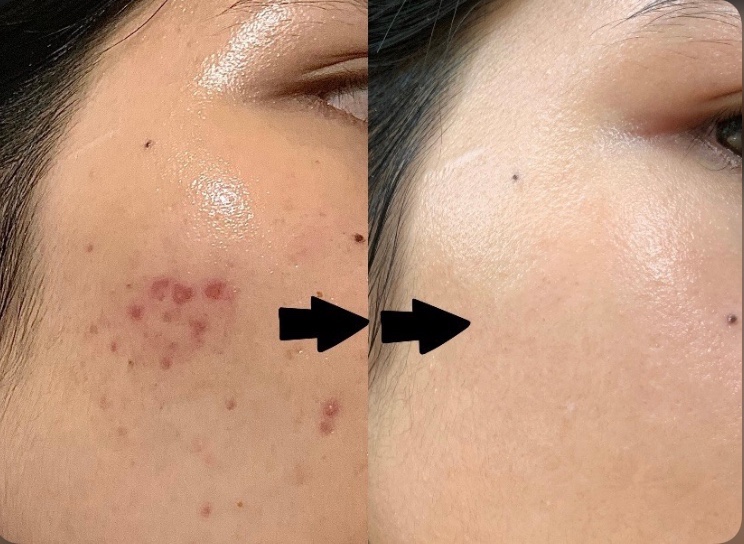 CÁCH TRỊ MỤN