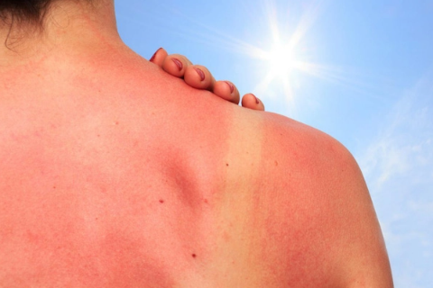 8 cách điều trị cháy nắng tại nhà