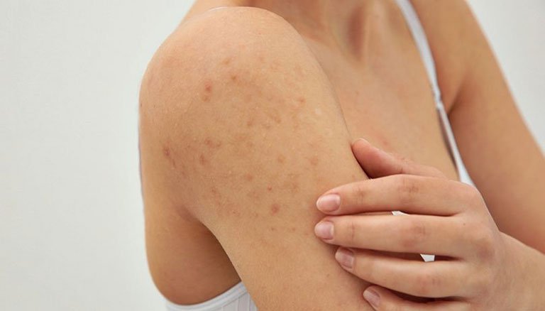 Nổi mụn trên cánh tay