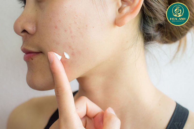 Hướng dẫn bôi thuốc trị mụn đúng cách