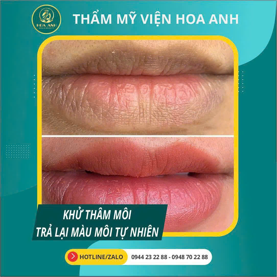 Nam Giới Có Nên Khử Thâm Môi Không? Góc Nhìn Hiện Đại Và Lựa Chọn Đáng Cân Nhắc