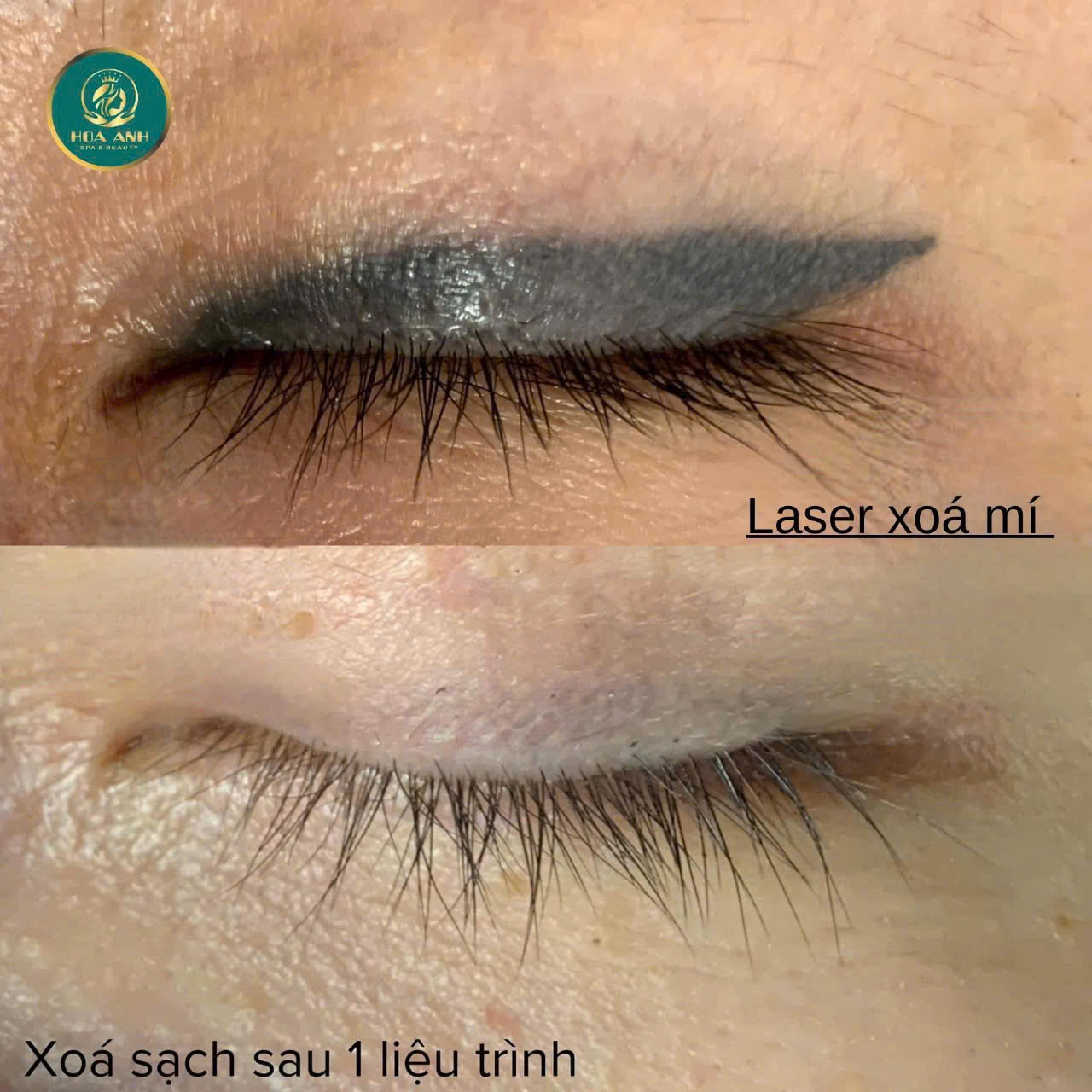 Xóa Mí Mắt: Giải Pháp Khắc Phục Mí Mắt Lỗi An Toàn & Hiệu Quả