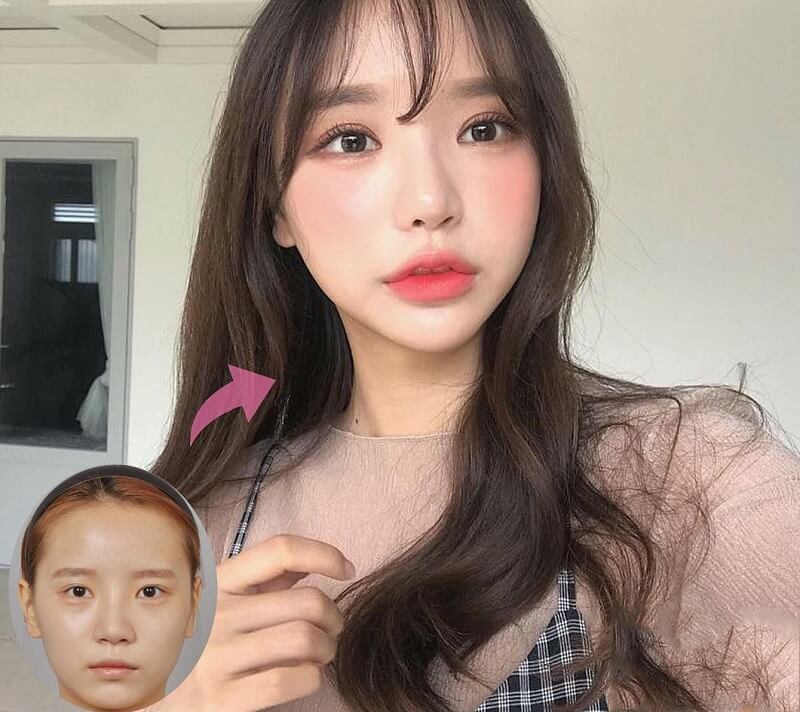 Ưu và nhược điểm của phương pháp tiêm filler hạ gò má