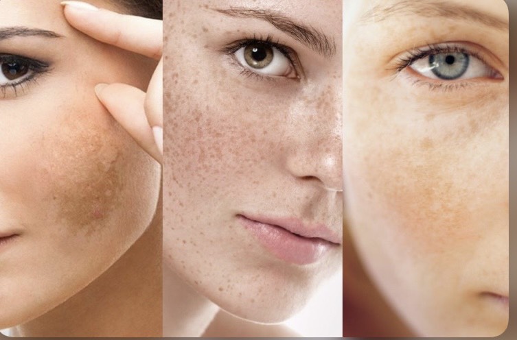 Bị nám tàn nhang lâu năm có chữa được không?