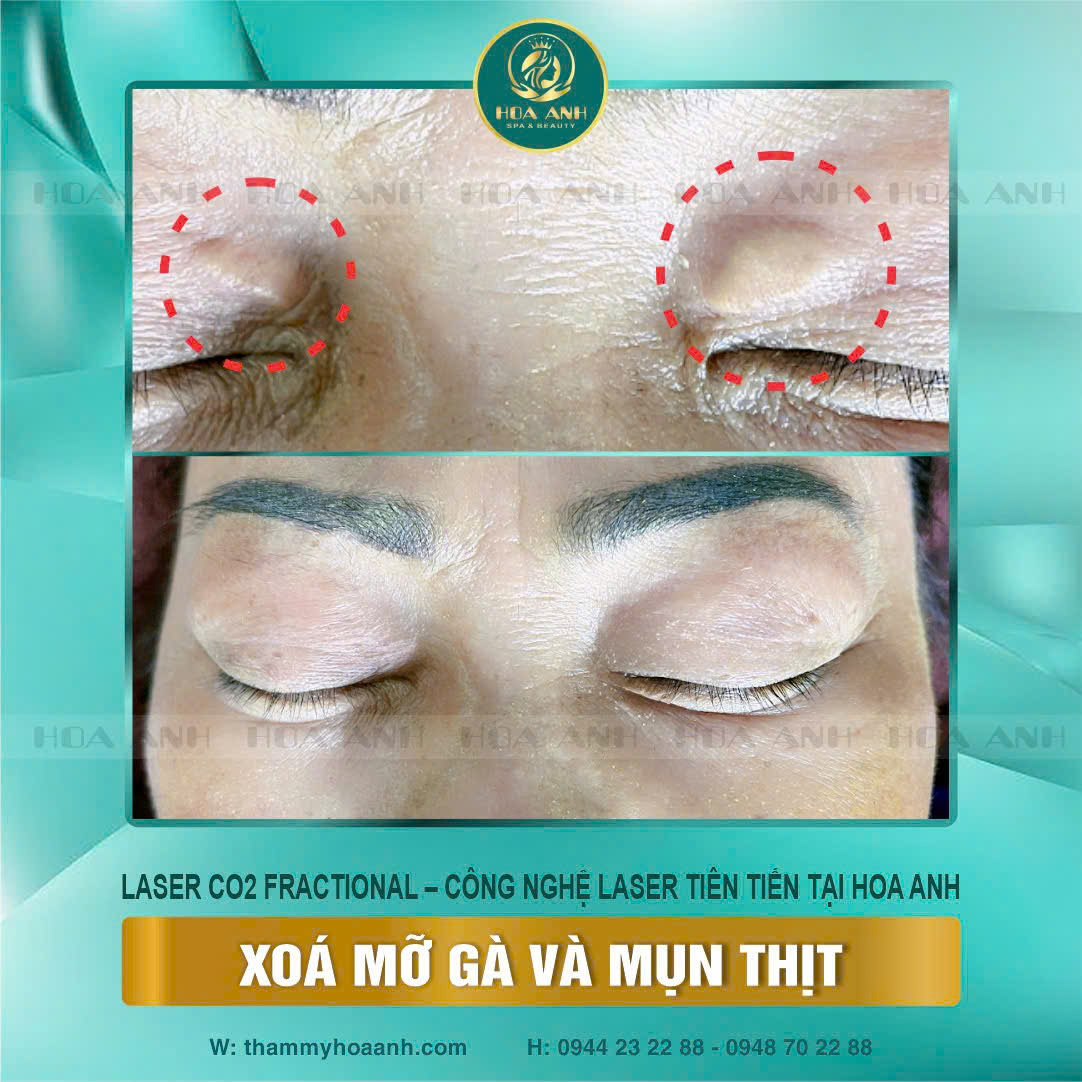 Xóa Mỡ Gà Và Mụn Thịt Bằng Laser CO2 Fractional: Giải Pháp Hiệu Quả, An Toàn Và Nhanh Chóng