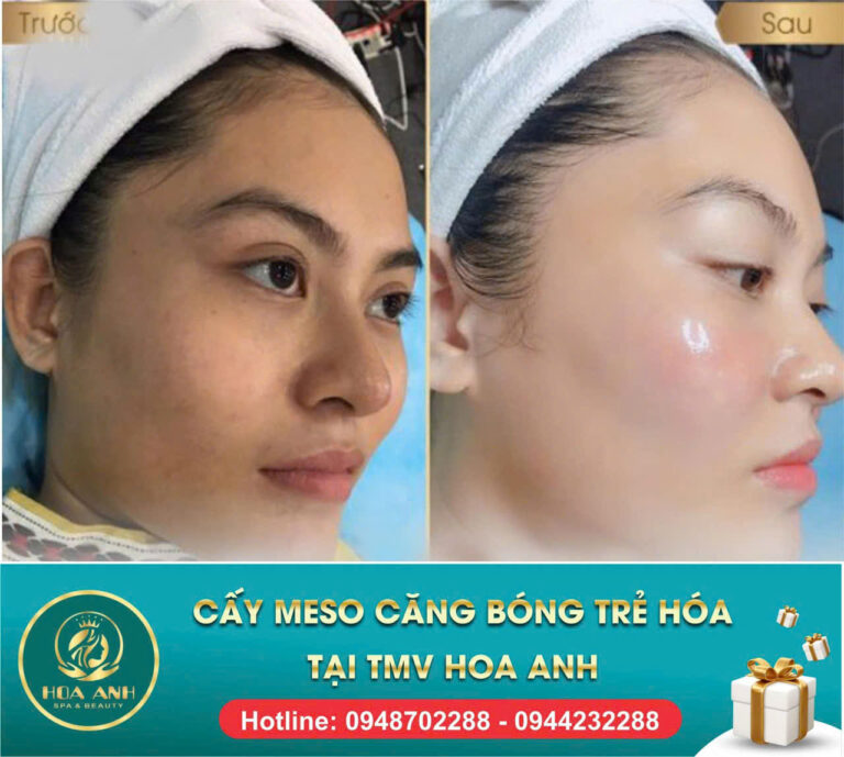Cấy Meso Trắng Da Có Thật Sự Hiệu Quả? Góc Nhìn Chuyên Môn Từ Thẩm Mỹ Viện Hoa Anh