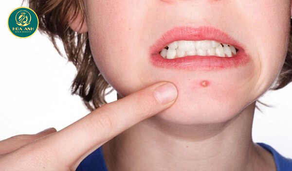 Cách trị mụn đầu đinh dân gian