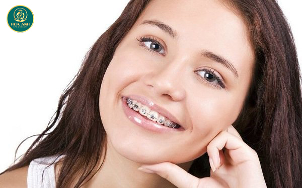 Vì sao bạn bị hóp má và thái dương khi niềng răng?