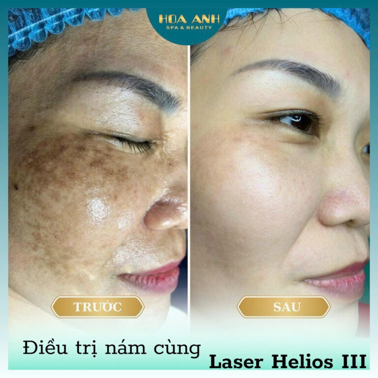 Điều Trị Nám Tại Nhà Có Hết Không Và Có Tác Hại Gì Không?