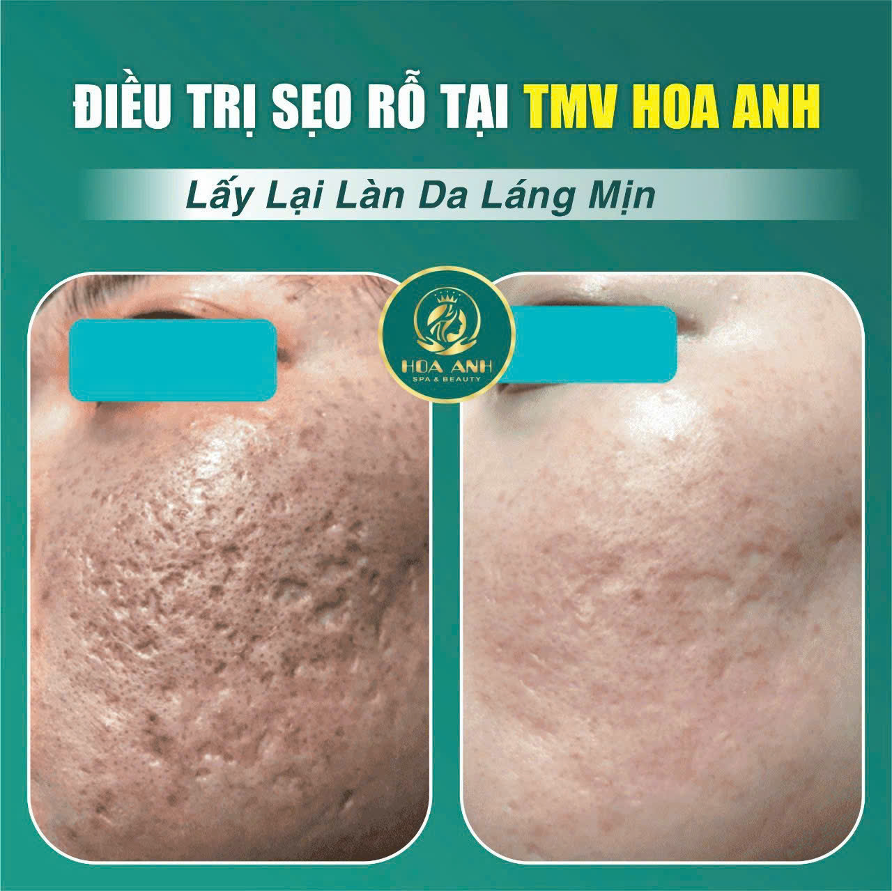 Điều Trị Sẹo Rỗ: Phương Pháp Hiệu Quả & Lưu Ý Quan Trọng