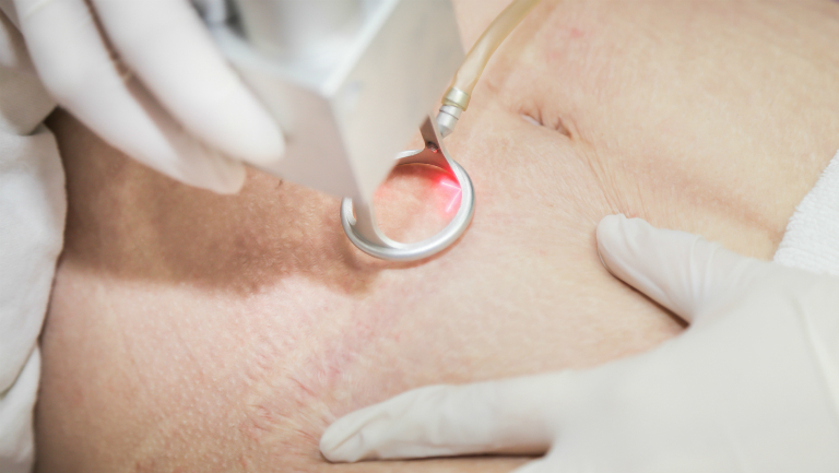 Trị rạn da bằng laser bao nhiêu tiền?