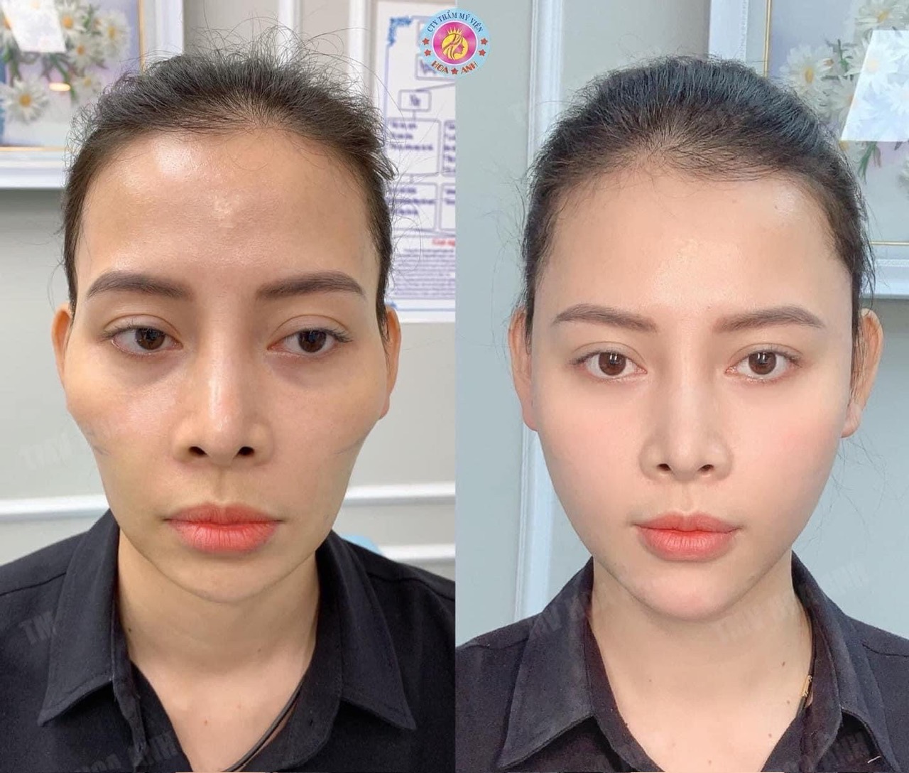 TIÊM FILLER: LỢI ÍCH VÀ MỐI NGUY HIỂM BẠN CẦN BIẾT TRƯỚC KHI QUYẾT ĐỊNH