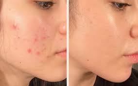 CÁCH CHĂM DA MỤN TẠI NHÀ
