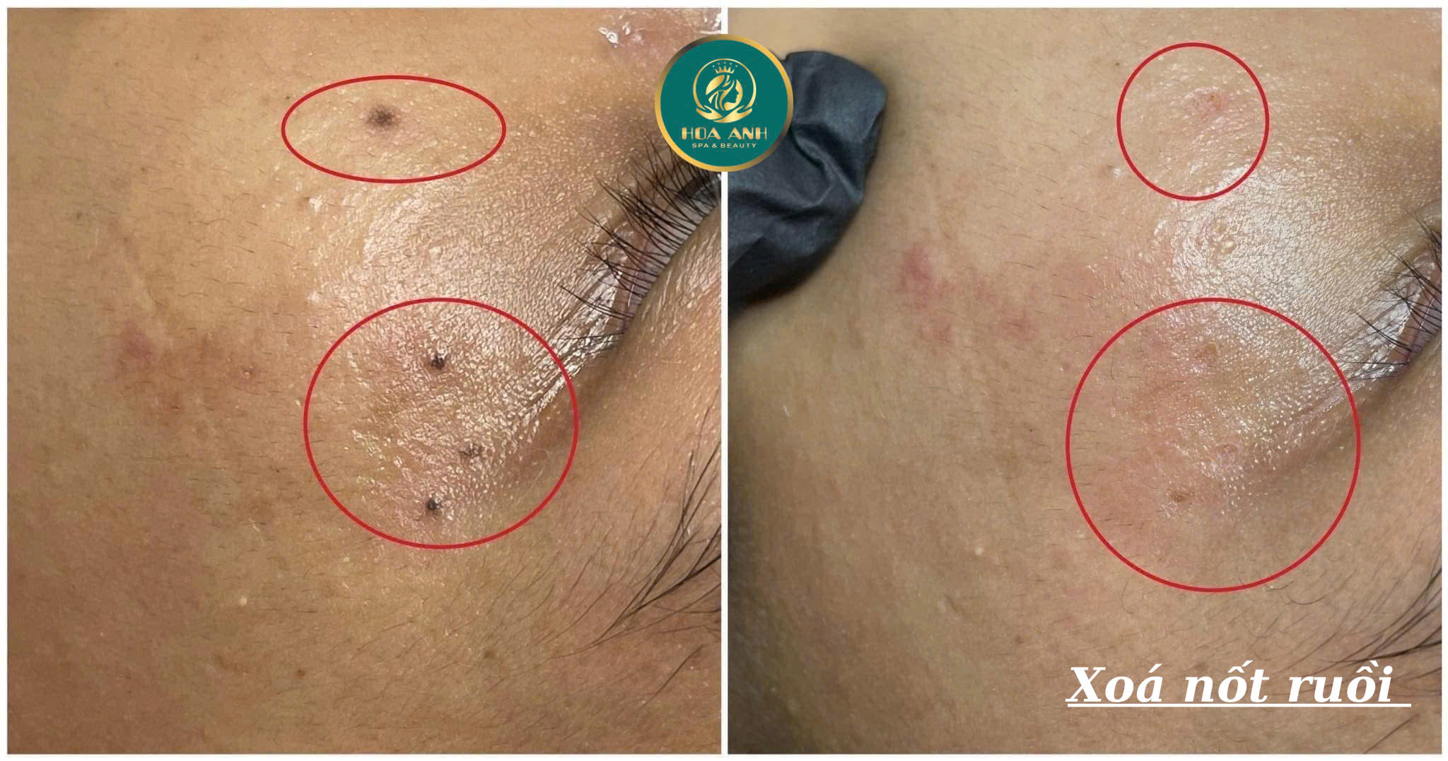 Xóa nốt ruồi bằng laser có hết không? Chia sẻ thực tế từ Thẩm mỹ viện Hoa Anh