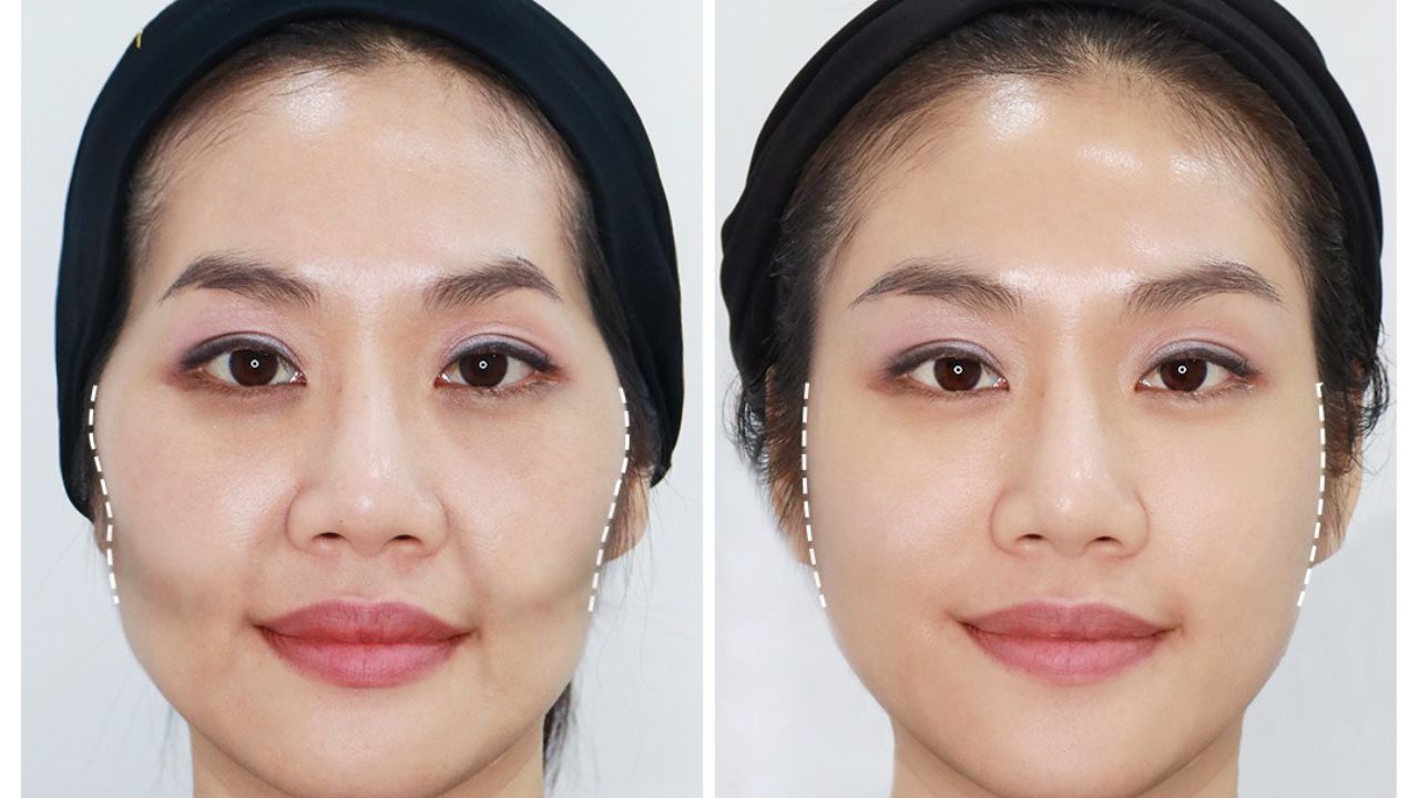 LÀM ĐẦY MÁ HÓP