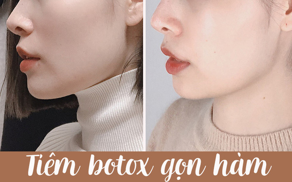 Tiêm thon gọn hàm giá bao nhiêu? Bảng giá cập nhật mới nhất