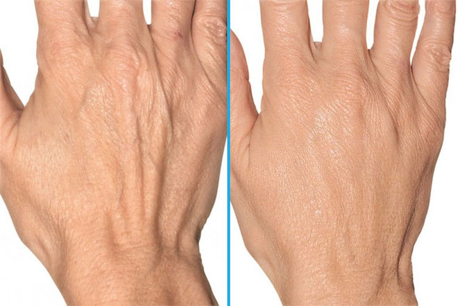 How much does hand filler injection cost?