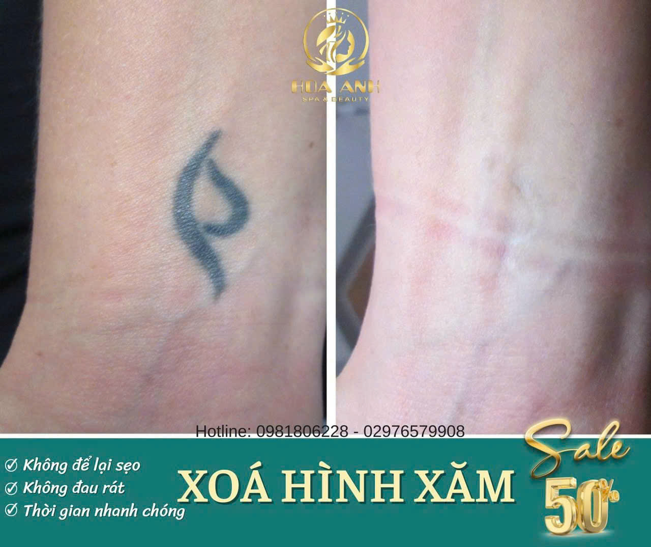 Xóa Xăm Có Đau Như Lời Đồn Không? – Chia Sẻ Thật Từ Thẩm Mỹ Viện Hoa Anh
