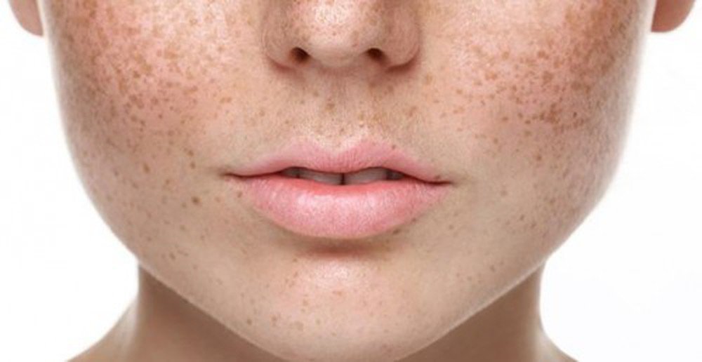 CÁCH TRỊ NÁM TÀN NHANG, NÁM MẢNG, NÁM CHÂN SÂU
