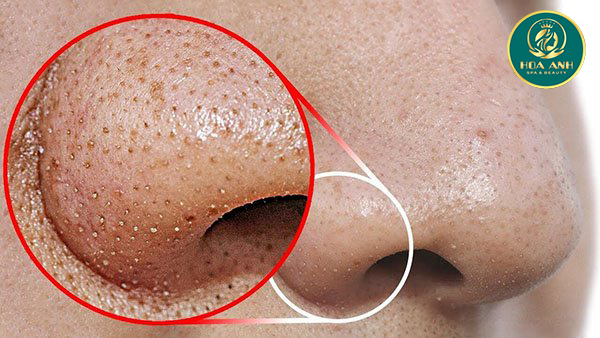Cách trị mụn đầu đen ở mũi hiệu quả tại nhà