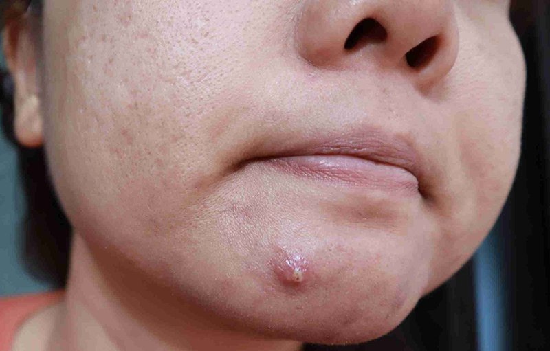 Có nên nặn mụn bọc có mủ không?