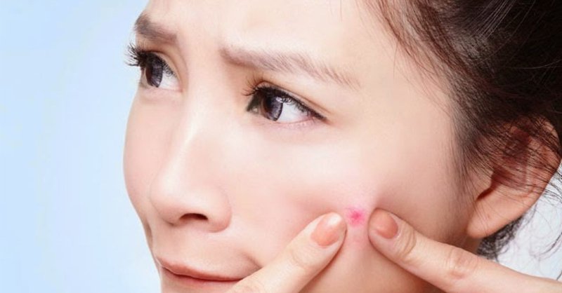 Làm thế nào để nặn mụn một cách an toàn?