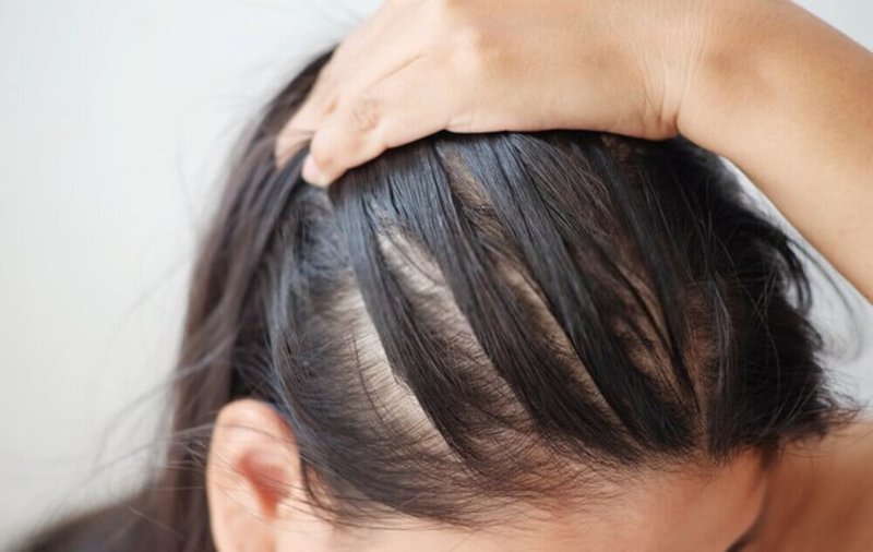 Cách chăm sóc tóc khi có da dầu nhờn dính