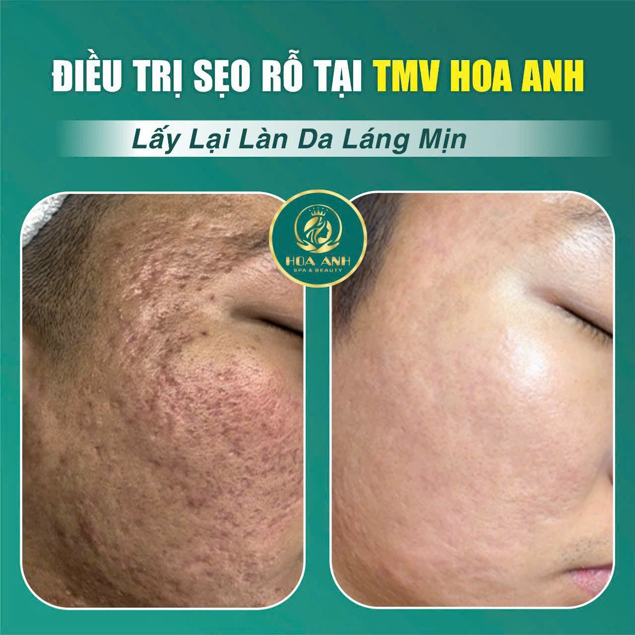 Sẹo rỗ có trị được không? Chuyên gia Thẩm mỹ viện Hoa Anh chia sẻ bí quyết phục hồi làn da mịn màng