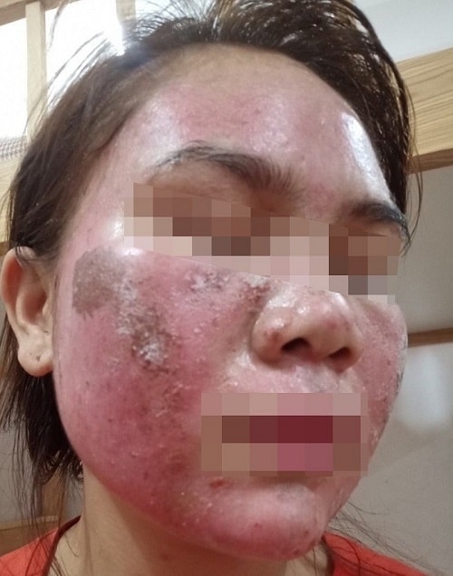 Tác Hại Của Việc Peel Da Không Đúng Cách