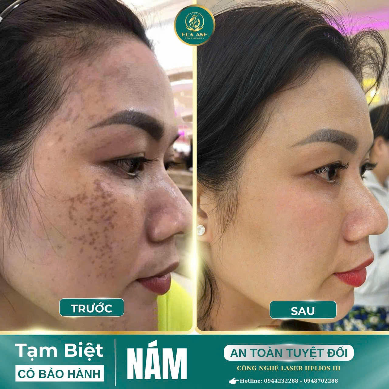 Chăm Sóc Da Sau Khi Laser Điều Trị Nám Mảng Đúng Cách – Bí Quyết Giữ Da Khỏe Đẹp Từ Thẩm Mỹ Viện Hoa Anh