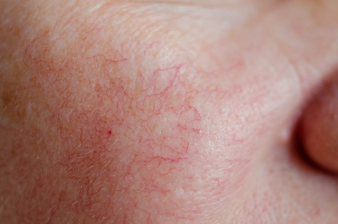 Cách chăm sóc da mỏng nổi mạch máu cho da khỏe mạnh