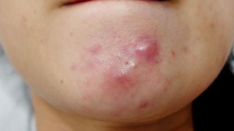 Trị mụn nang từ trong ra ngoài