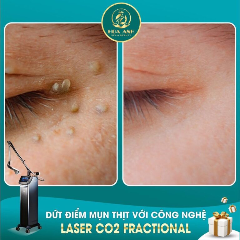 Mụn Thịt Làm Mất Thẩm Mỹ Như Thế Nào? Nguyên Nhân, Tác Hại Và Cách Khắc Phục Tận Gốc