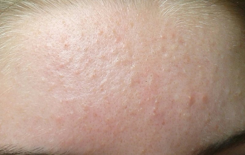 Mụn ẩn dưới da: Trị mụn trong 3 bước